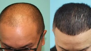 Save Your HairLine With Finasteride amp Minoxidil  How To Use  Dose hairclub hairstyle haircut [upl. by Selrahcnhoj90]