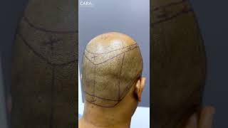 Cara Clinics REAL Hair Transplant Results That Will SHOCK You [upl. by Branch323]