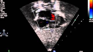 Subcostal 4 chamber view 2D with color [upl. by Swor]