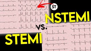 ECG interpretation  STEMI vs NSTEMI  ECG of Myocardial Infraction • Daily Cardiology [upl. by Parks316]