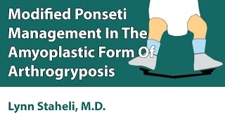 Modified Ponseti Management In The Amyoplastic Form Of Arthrogryposis [upl. by Anailuig]