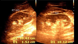 Angiomyolipoma  Renal Mass  Renal Tumor [upl. by Led]