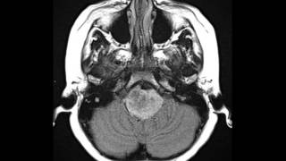 Brainstem Glioma Low Grade [upl. by Elockin]