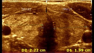 Understanding Ultrasonographic Features of Chronic Thyroiditis [upl. by Salta542]