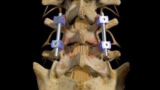 L45 Posterior Interbody Fusion [upl. by Daffi375]