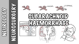 Subarachnoid Haemorrhage  pathophysiology complications and management [upl. by Ahsiea138]