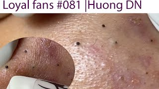 Acne Treatment Huong Da Nang 081  Loyal fans [upl. by Orvan440]