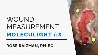 Improve Wound Measurement Accuracy with the MolecuLight iX [upl. by Srini555]