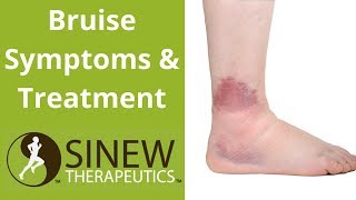 Bruise Symptoms and Treatment [upl. by Ayvid]