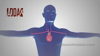 subclavian steal syndrome angiography animation [upl. by Nairoc]