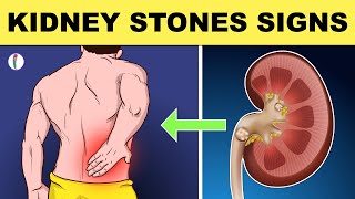 Kidney Stones Symptoms  All You Need to Know [upl. by Kelcey642]