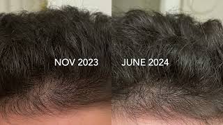 Dutasteride vs Finasteride Before amp After 7 month comparison [upl. by Tedder853]