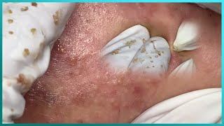 Big Cystic Acne Blackheads Extraction Blackheads amp Milia Whiteheads Removal Pimple Popping [upl. by Bobina590]