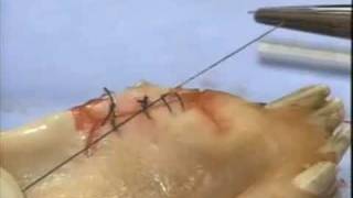 Introduction to Periodontal Surgery Techniques Initial Incisions and Suturing [upl. by Enirual242]