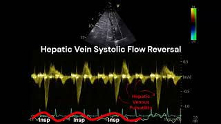 Systolic Reversal of Hepatic Vein Flow What does it means [upl. by Auqinahc]