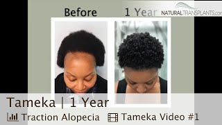 1 Year Results Traction Alopecia Patient with Remarkable Progress  Dr Huebner Tameka [upl. by Arual]