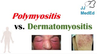 Idiopathic Inflammatory Myopathies  Polymyositis vs Dermatomyositis [upl. by Honan128]