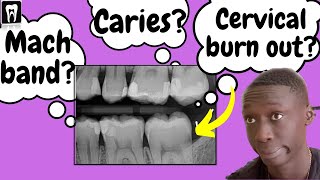 Caries Vs Cervical burnout Vs Mach band effect  Interpretation of Dental Caries [upl. by Nylrats]