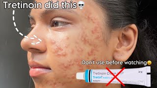 Tretinoin mistakes that ruined my skin 😫 tretinoin skincare beauty [upl. by Ahseem628]