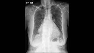 cardiomegaly CTpericardial effusion [upl. by Anitra810]