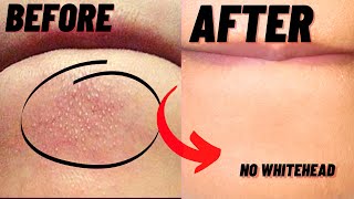 How To Remove Whiteheads And Blackheads From Chin At Home [upl. by Laspisa608]