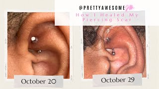 How I Healed My Hypertrophic Piercing Scar  Photo Timeline [upl. by Aitekram14]