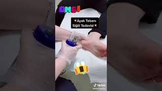 Ayak Tabanı Siğil Tedavisi 🦶🏻Dermatolog Doç Dr Berna Aksoy [upl. by Elliven]