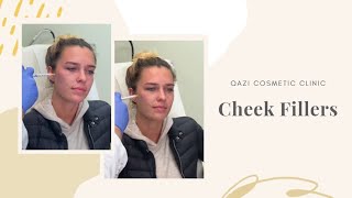 Cheek Fillers Using Radiesse  Live with Dr Nadir Qazi [upl. by Andreana]