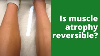 Is muscle atrophy reversible [upl. by Ruthe263]