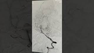 What is DSA  brain angiography  brain angiogram headache dsa head health [upl. by Angele641]