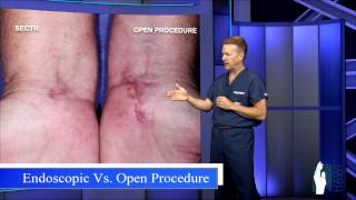 Carpal Tunnel Release  Open Procedure vs Endoscopic [upl. by Nnylassej]