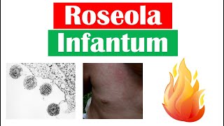 Roseola Infantum Sixth Disease  Symptoms Fever amp Rash in Infants Diagnosis Treatment [upl. by Manaker]