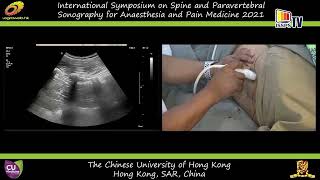 Ultrasound Imaging of the Lumbar Spine Sonoanatomy Demonstration in Volunteers Dr MK Karmakar [upl. by Hussar]