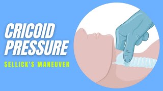 Cricoid pressure  Technique [upl. by Wattenberg940]