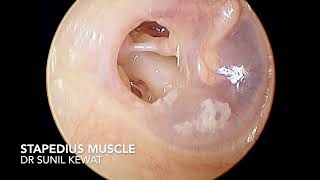 Glimpses of Stapedius Muscle and Stapes Bone  Otoendoscopy  Dr Sunil Kewat [upl. by Tirreg]