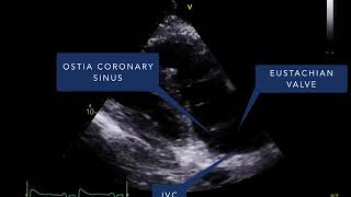 2D echo examination [upl. by Cornell]