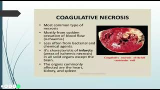 Necrosis  Pathology Learning [upl. by Orson728]