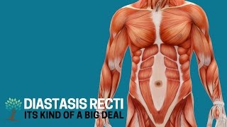 Heres Why Diastasis Recti is a Big Deal  Diastasis Ed 1 [upl. by Tolecnal]