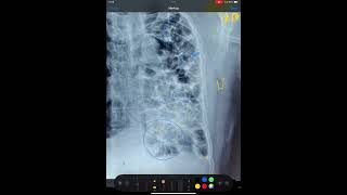 BRONCHIECTASIS FIBROSIS OF LUNGS MEDIASTINAL SHIFT X RAY CHEST [upl. by Settle]