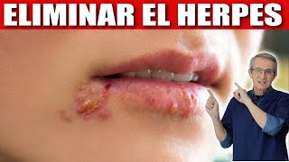 Cómo ELIMINAR el HERPES [upl. by Dee]