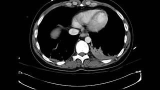 What is your diagnosis Myocardial infarct on Chest CT [upl. by Bein880]