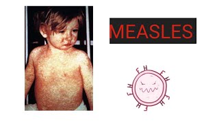 MEASLES Causes Pathology Symptoms Diagnosis Treatment Vaccination Care  What is Measles [upl. by Lotus]