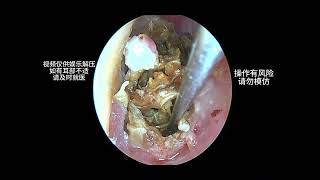 Cleaning a large amount of earwax that severely blocks the ear canal earwaxremoval earwax cleaning [upl. by Esilahc]