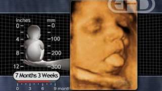 Fetus 7 12 months  Breathing Movements [upl. by Otto]