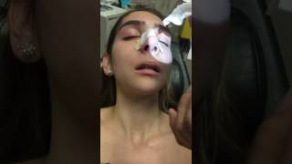 Removing a Nasal Stent 5 Days after Rhinoplasty [upl. by Isiah]