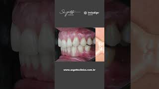 Caso de retratamento ortodôntico com Invisalign® [upl. by Hanni656]