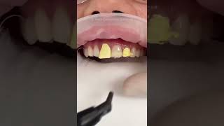 8 teeth composite bonding 🤍💫 [upl. by Sidnee]