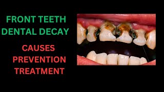 TEETH DECAY IN FRONT TEETH  EVIDENCE BASED DENTAL DECAY MANAGEMENT IN FRONT TEETH [upl. by Addia]