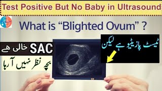 Pregnancy Test Positive But No Baby in Ultrasound  No HeartBeat at 6Weeks  Empty Sac UrduHindi 🌐 [upl. by Izabel344]