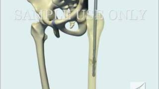 Femoral Fracture Fixation Surgery Intramedullary Nail [upl. by Margarete]